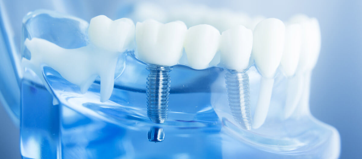 Modell eines Zahnimplantats aus Titan mit Krone – Implantologie in Langenfeld