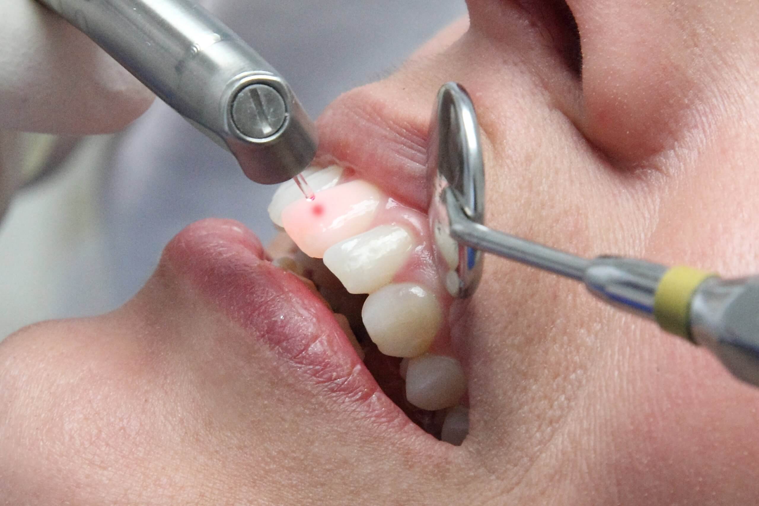 Zahnbehandlung mit dem Dentallaser – Zahnarztpraxis in Langfort, Langenfeld